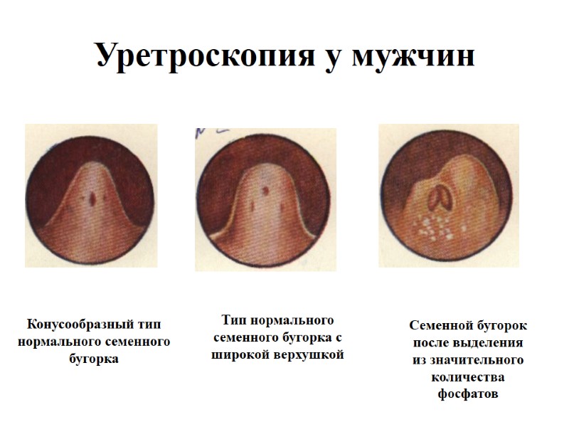 Уретроскопия у мужчин Конусообразный тип нормального семенного бугорка  Тип нормального семенного бугорка с